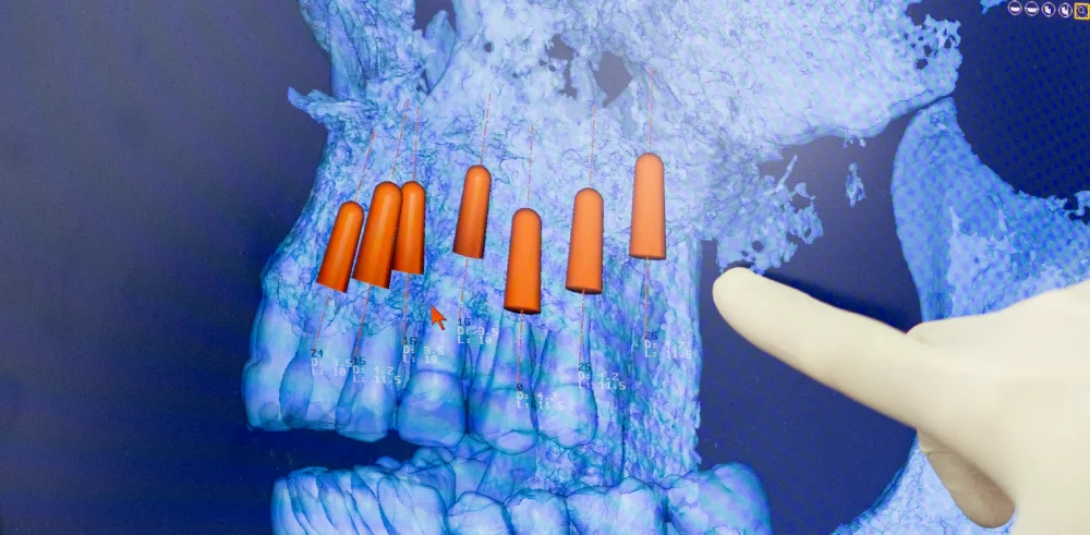 Implante dental en barcelona