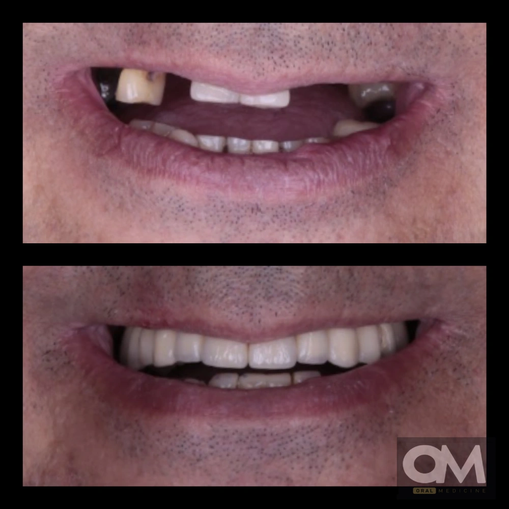 antes y después de Implantes dentales barcelona