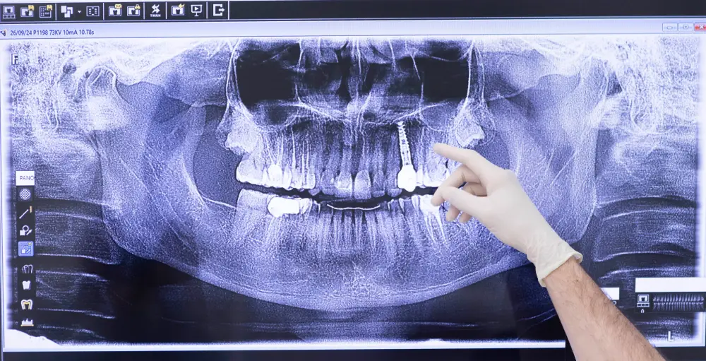 implante dental barcelona