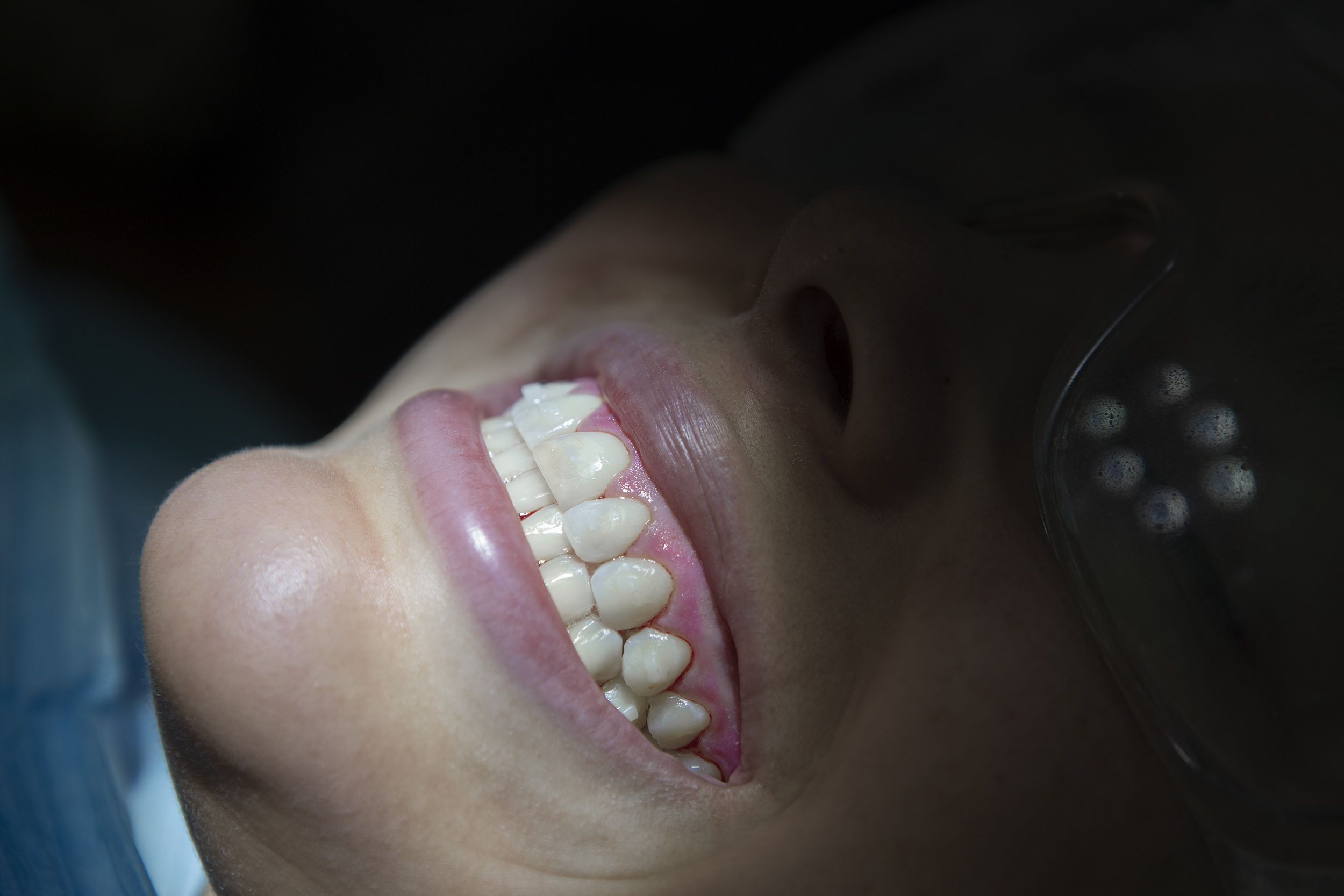Limpieza dental biozero