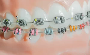 funcionamiento brackets