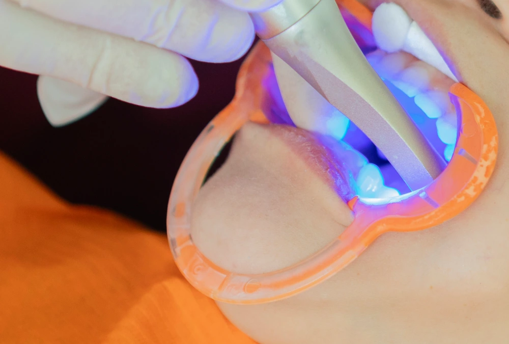 tratamiento de composite dental - resina dental